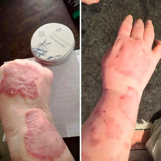 Psoriasis eli psoriaasi: hoito ja oireiden lieventäminen