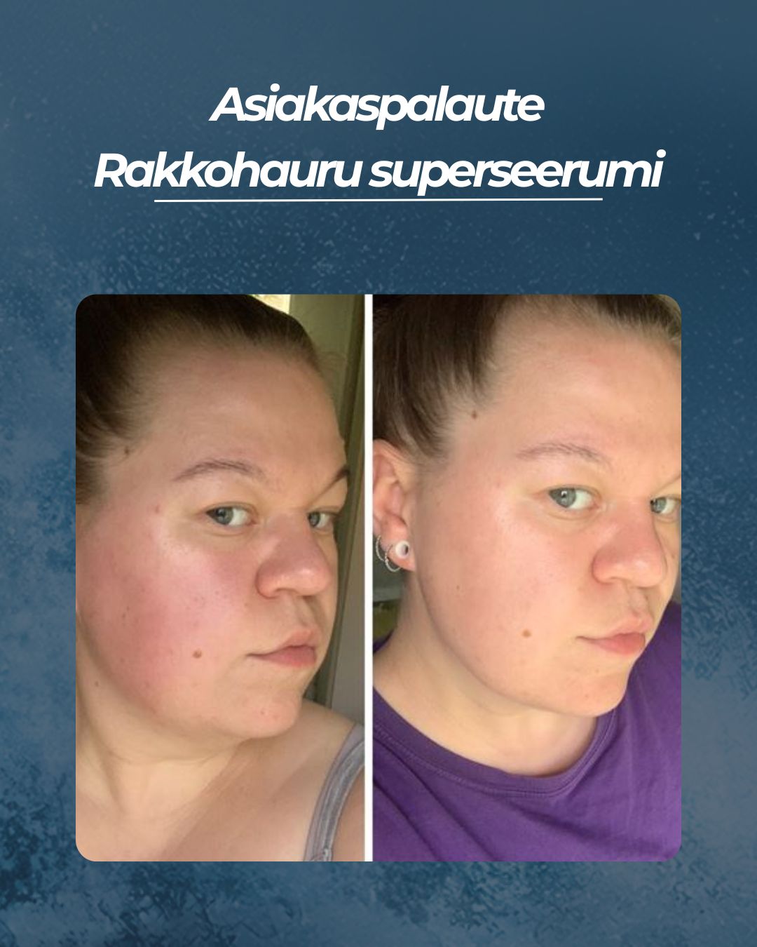 Asiakaspalaute
Rakkohauru superseerumi
