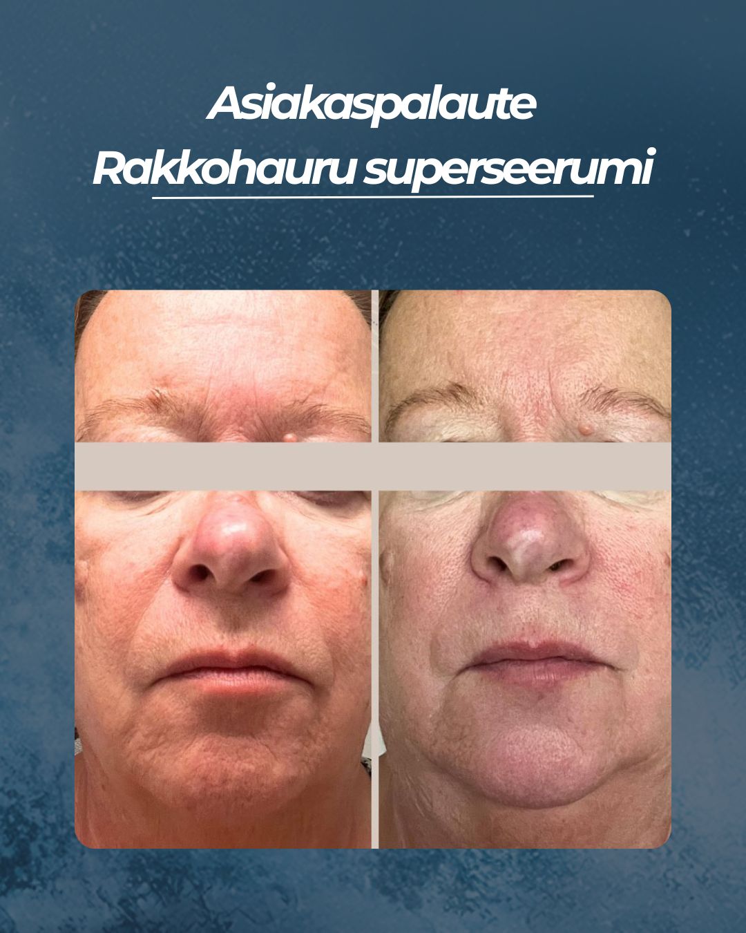 Asiakaspalaute
Rakkohauru superseerumi
