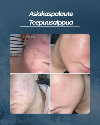Teepuusaippua akneiholle ja epäpuhtauksiin sekä atooppiselle tai kutisevalle iholle, kaikille ihotyypeille, 100% luonnollinen, UNISEX