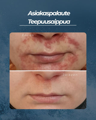 Teepuusaippua akneiholle ja epäpuhtauksiin sekä atooppiselle tai kutisevalle iholle, kaikille ihotyypeille, 100% luonnollinen, UNISEX