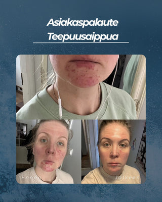 Teepuusaippua akneiholle ja epäpuhtauksiin sekä atooppiselle tai kutisevalle iholle, kaikille ihotyypeille, 100% luonnollinen, UNISEX
