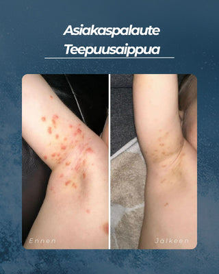 Teepuusaippua akneiholle ja epäpuhtauksiin sekä atooppiselle tai kutisevalle iholle, kaikille ihotyypeille, 100% luonnollinen, UNISEX