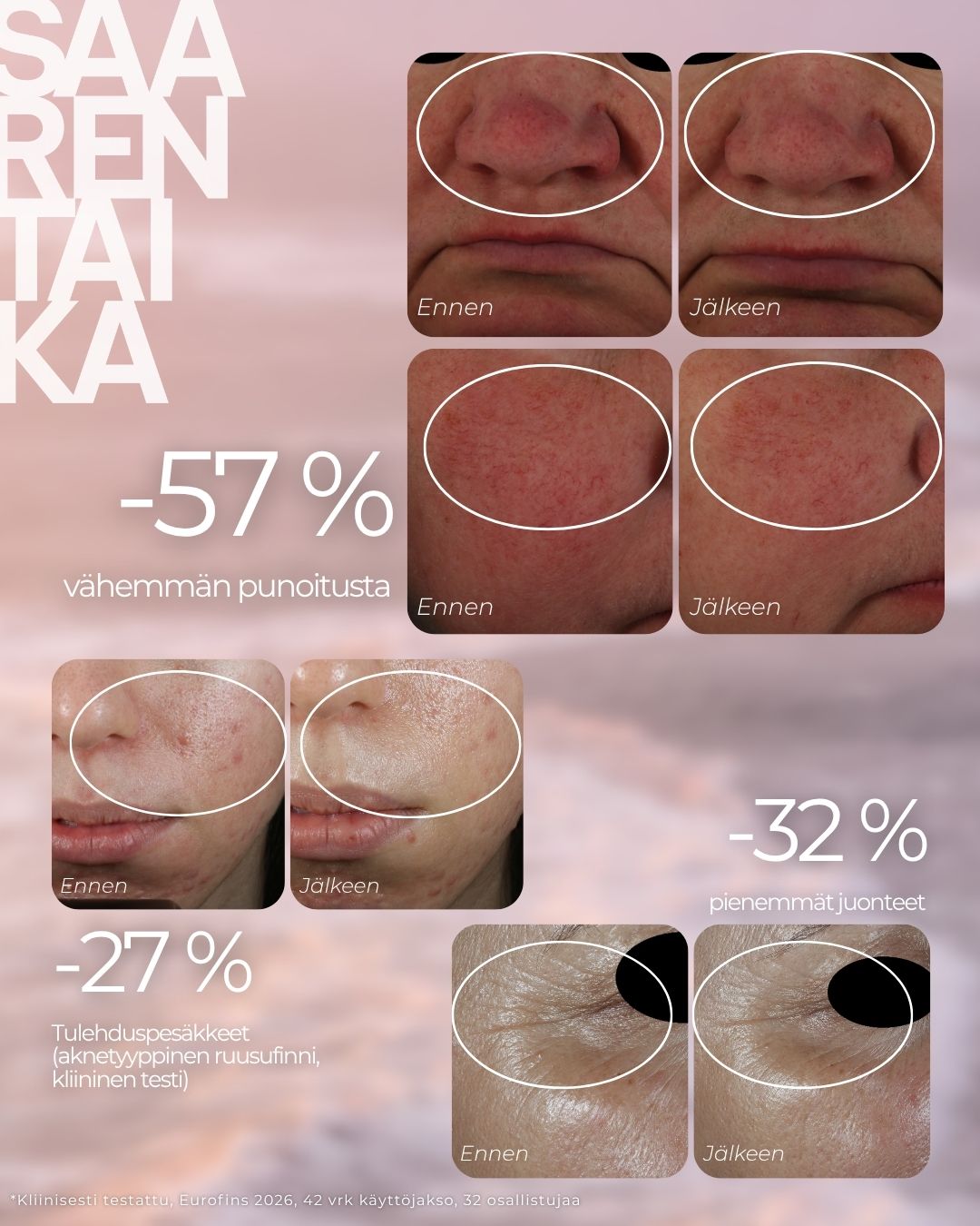 Punoitusta rauhoittava suojamuuria vahvistava seerumi on kehitetty ruusufinniin taipuvaiselle ja reagoivalle iholle. Se on kliinisesti testattu, ja dermatologin valvomassa tutkimuksessa punoitus väheni 57 % 42 vuorokauden käytön jälkeen, ja myös kuumotuksen, kirvelyn ja kireyden tunne helpotti merkitsevästi.