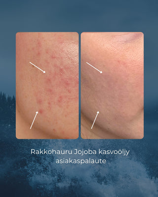 Rakkohauru Jojoba kasvoöljy ärtyneelle, punoittavalle ja epäpuhtauksiin taipuvalle iholle, vegaaninen, 100% luonnollista