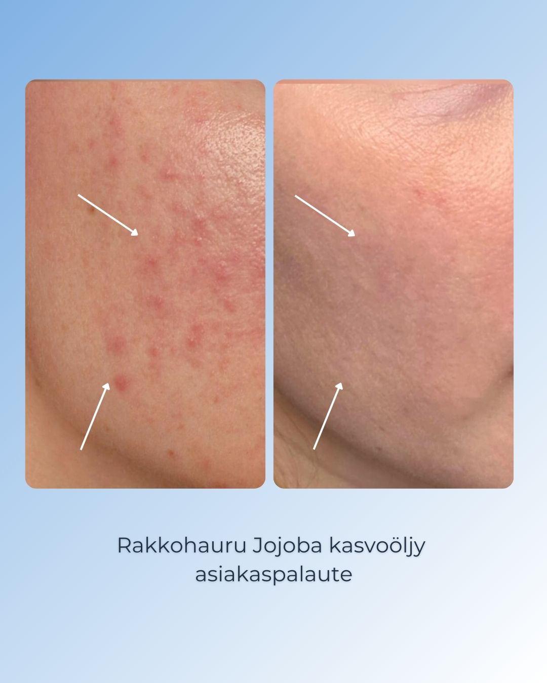 Rakkohauru Jojoba kasvoöljy tehoaa epäpuhtauksia vastaan ja tukee ihosi tasapainoa