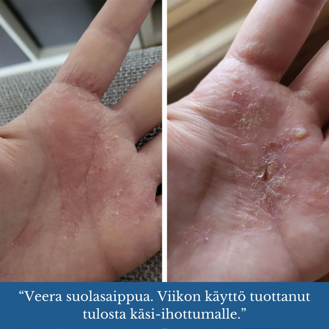 Veera Salt Soap®, adecuado para p. para erupciones cutáneas, acné y psoriasis piel, hidrata y calma la piel, 120g - Saaren Taika