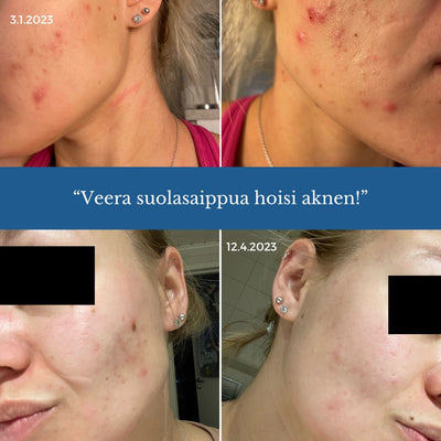 Veera Salt Soap®, adecuado para p. para erupciones cutáneas, acné y psoriasis piel, hidrata y calma la piel, 120g - Saaren Taika